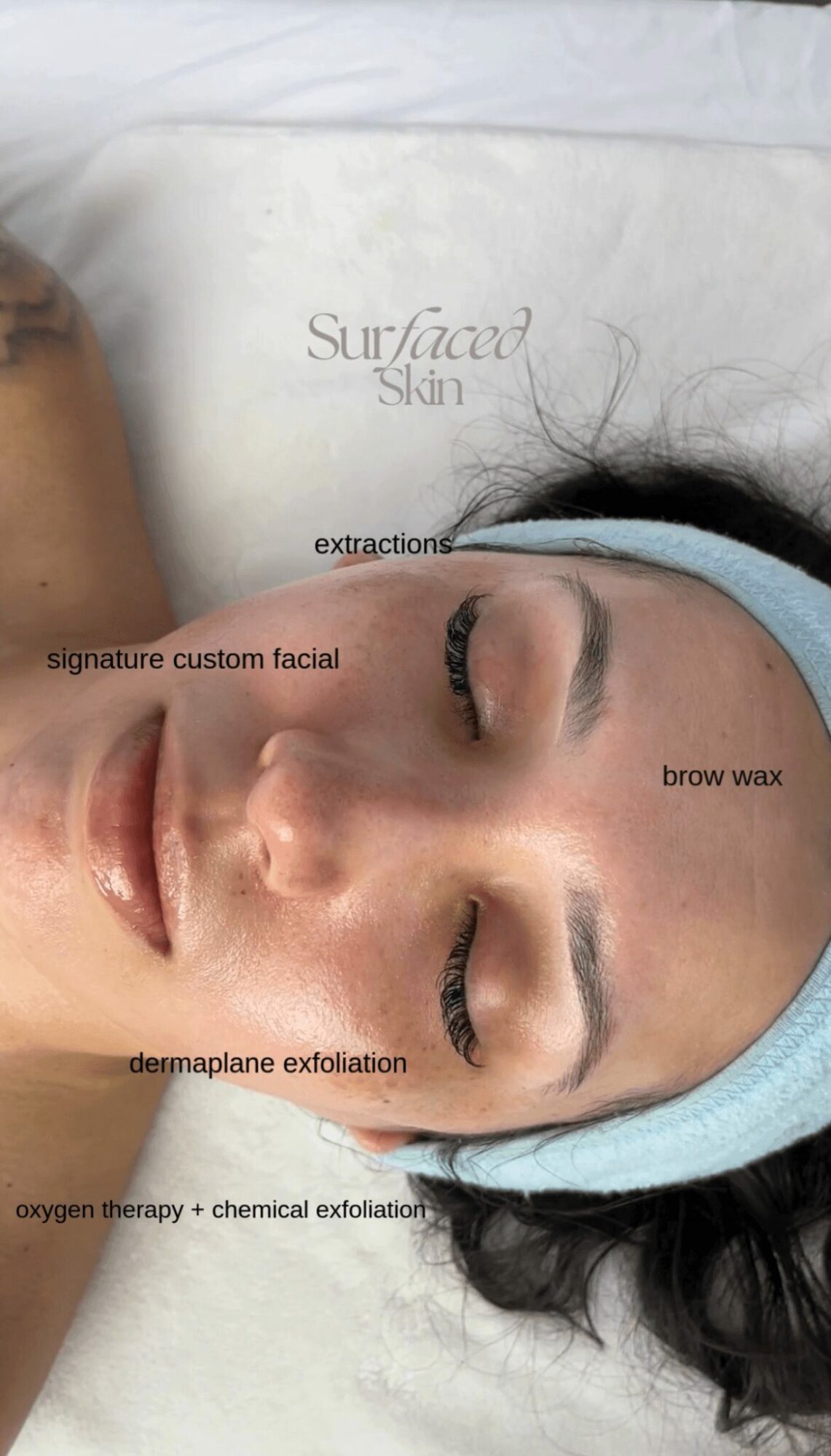 Close-up of a woman's face with labels for facial treatments, wearing a blue headband and lying down.