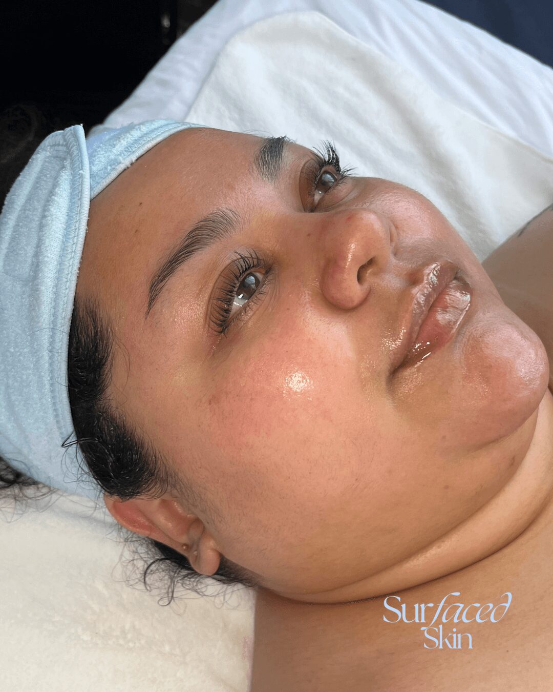 Close-up of a woman lying on a bed with a towel on her head, showing clear skin and relaxed expression.
