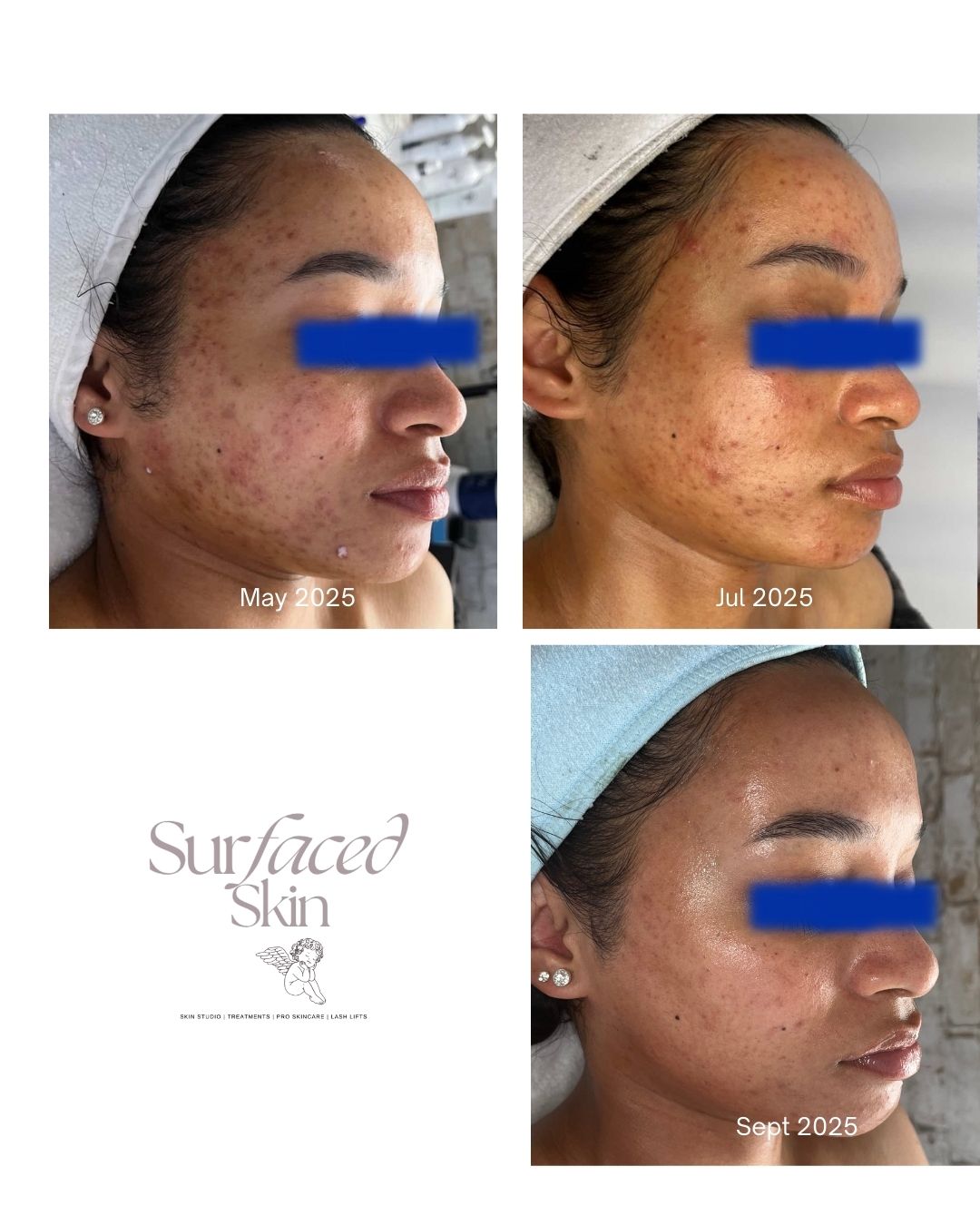 Three side-profile images of a woman showing skin improvement over months, with dates May, July, and September 2025.
