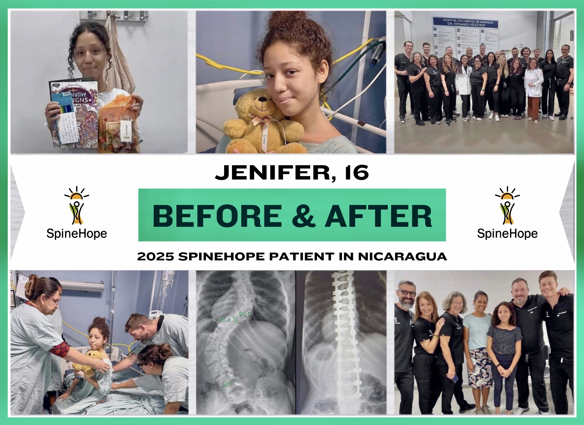 Collage of six images showing a young girl before and after spine treatment, with medical staff and group photos, SpineHope logo.