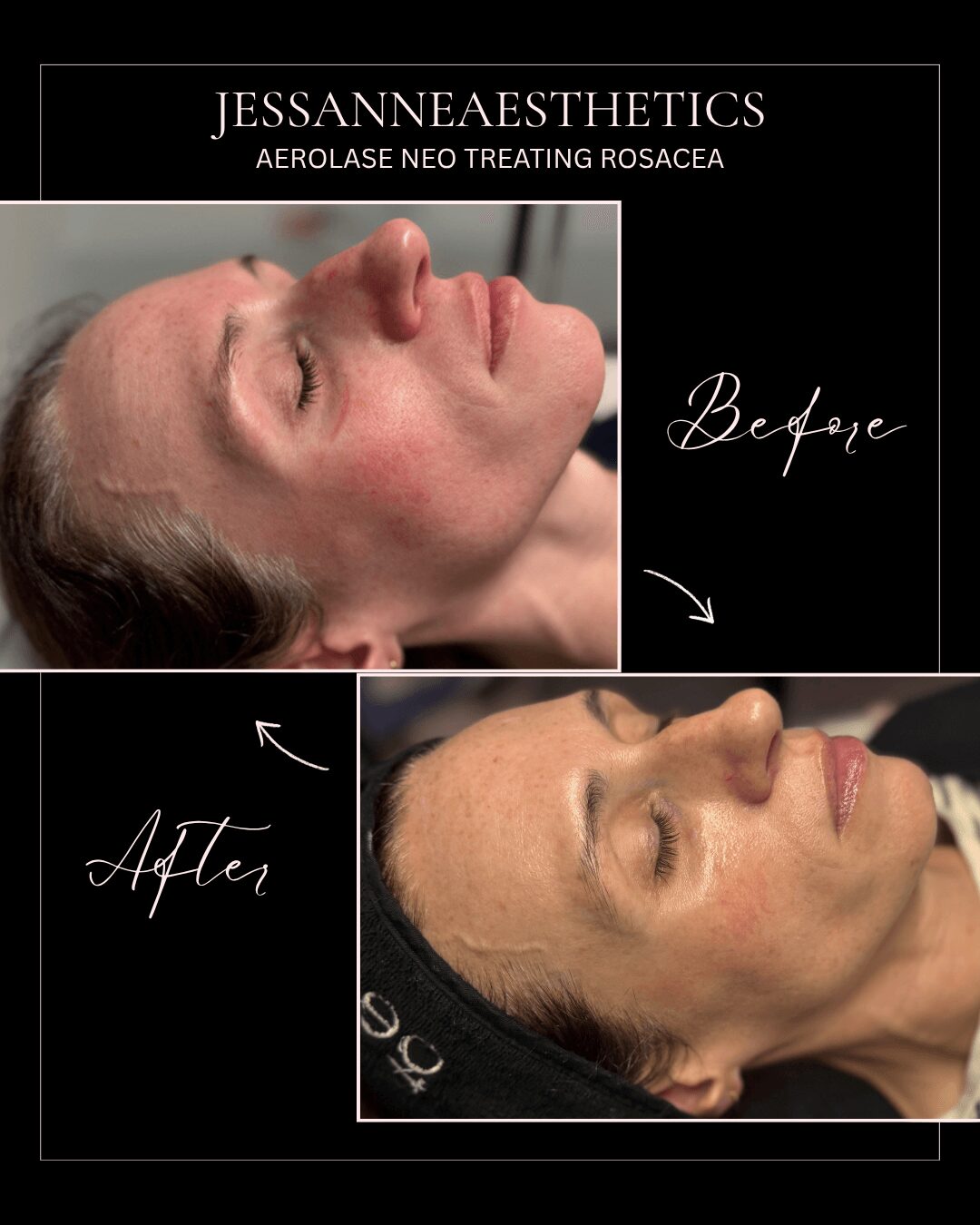 Comparison of before and after aesthetic treatment showing side profile of a woman's face with closed eyes, skin smooth, relaxed.