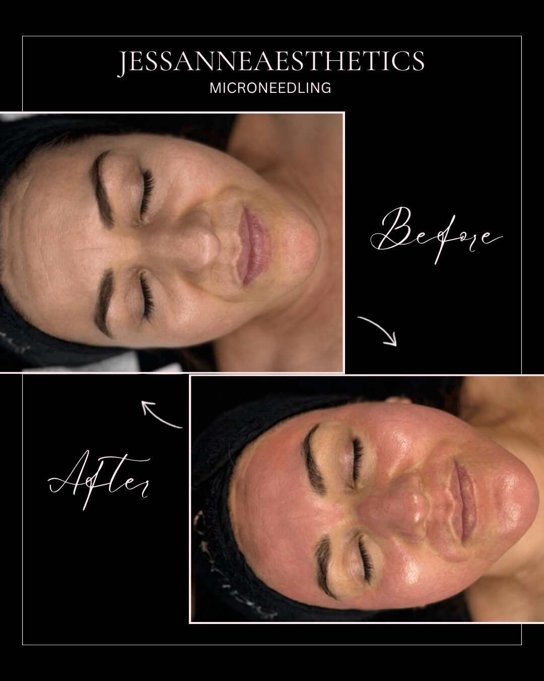 Comparison of a woman's face before and after microneedling treatment, showing skin improvement and reduced wrinkles.