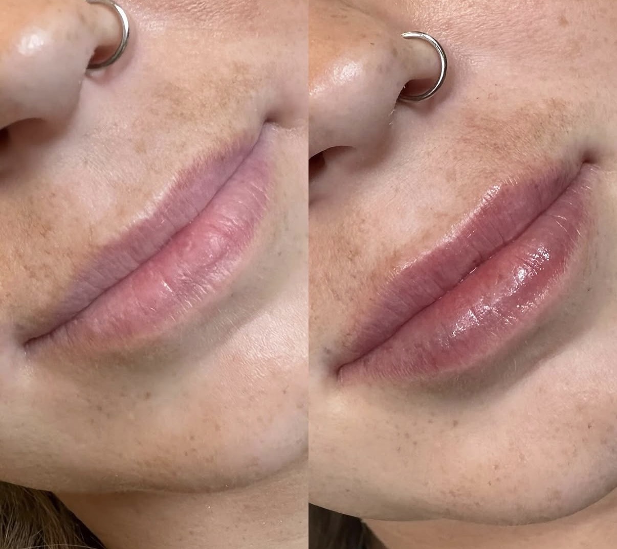 Close-up of lips and nose with piercings, showing before and after lip enhancement, side view, natural skin tone.