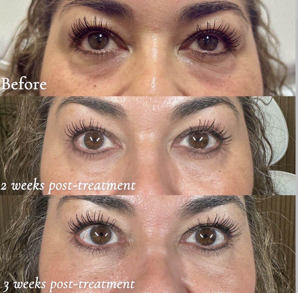 Close-up of eyes showing improvement over three weeks post-treatment, with visible reduction in under-eye puffiness and wrinkles.